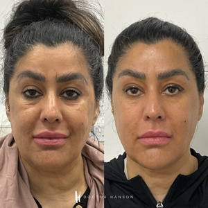 Endolift Before and After 2