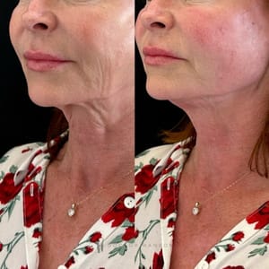 Endolift Before and After 3