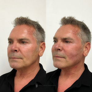 Endolift Before and After 4