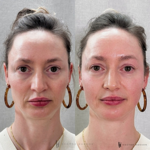 Endolift Before and After 5