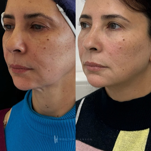 Endolift Before and After