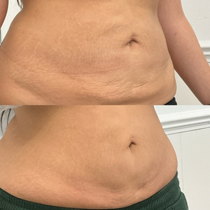 Endolift Tummy Before and After