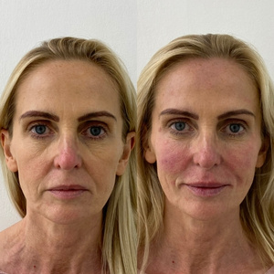 Full Face Rejuvenation Before and After 2