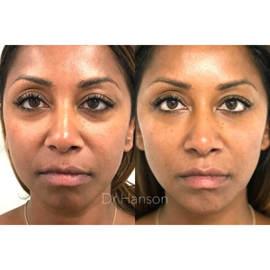 Full Face Rejuvenation Before and After 3