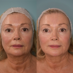 Full Face Rejuvenation London Before and After