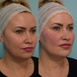 Liquid Lift Before and After 2