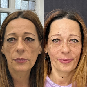 Liquid Lift Before and After 3