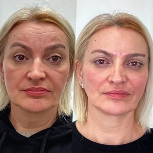 Liquid Lift Before and After 4