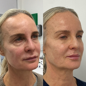 Liquid Lift Before and After