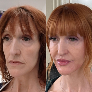 Liquid Lift London Before and After